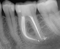 Behandelingen endodontologie